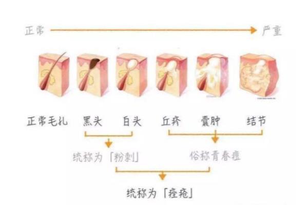 怎样护肤避免痘痘反弹呢（痘痘老是反复的看过来）.