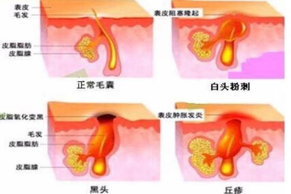 男生祛痘最好的方法（最好的祛痘方法是什么）.