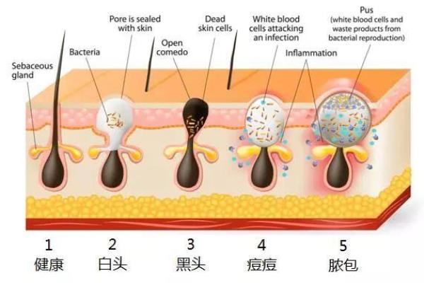 挤痘痘应该在洗脸前还是后（挤痘的正确方式）.