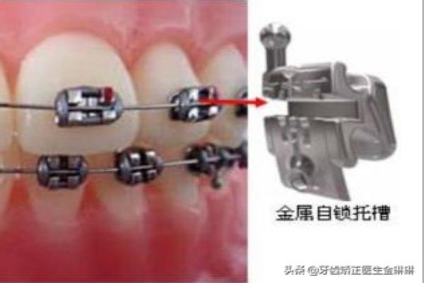 金属牙套和金属自锁牙套哪种更好一些.