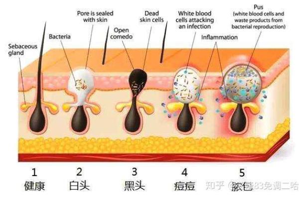 祛痘产品哪个品牌效果好.