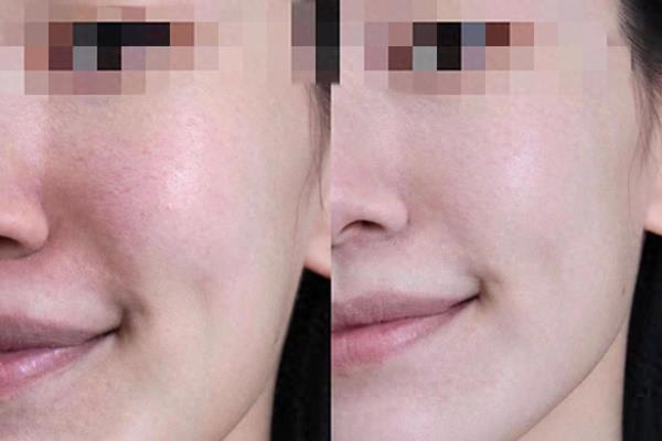 柳丝木隔离成分安全吗