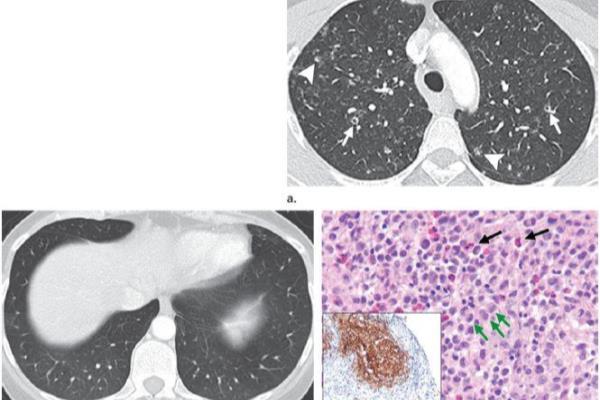 眼睛检查有朗格汉斯细胞是啥意思